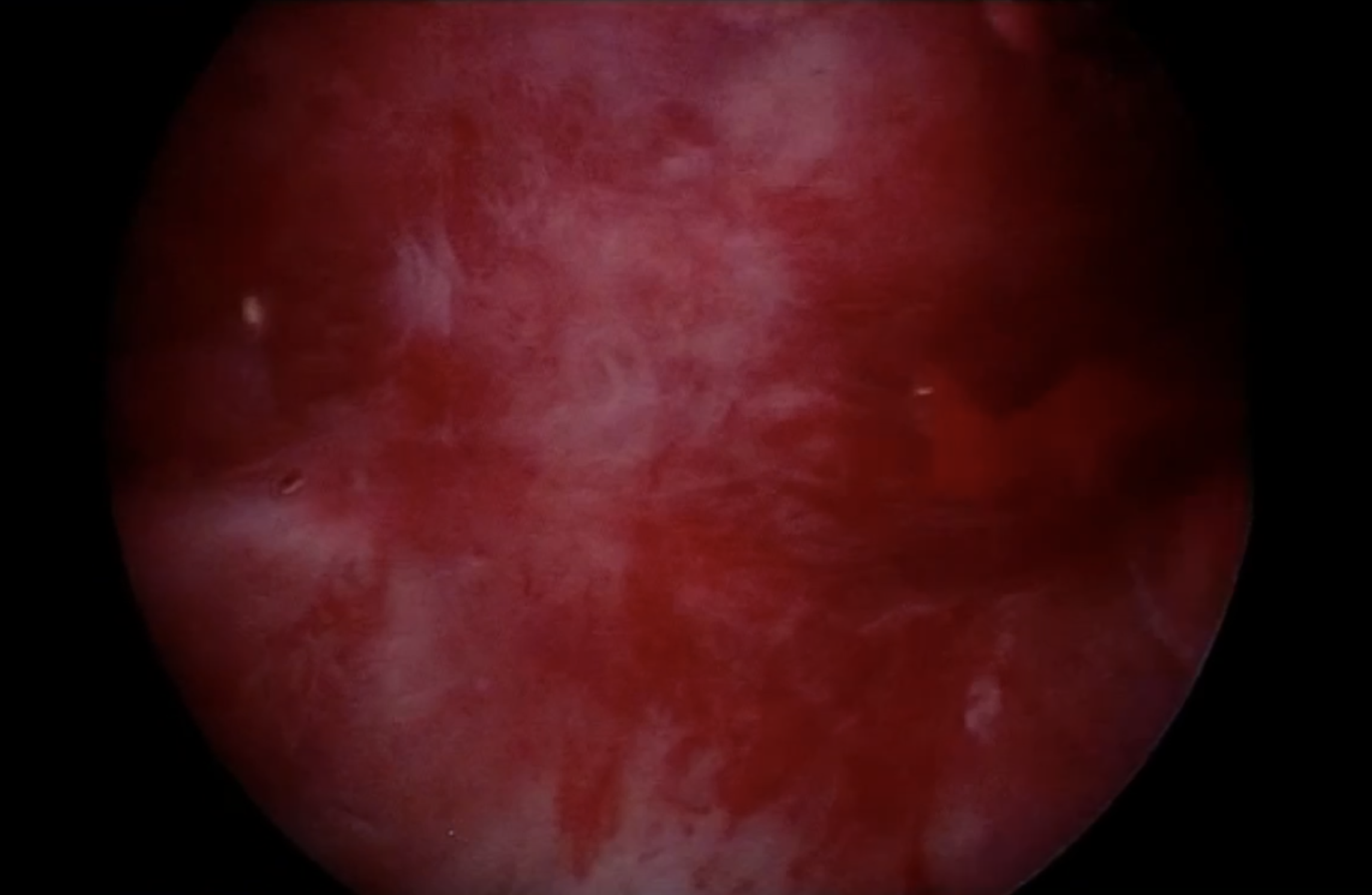 Vor der Novasure Ablation